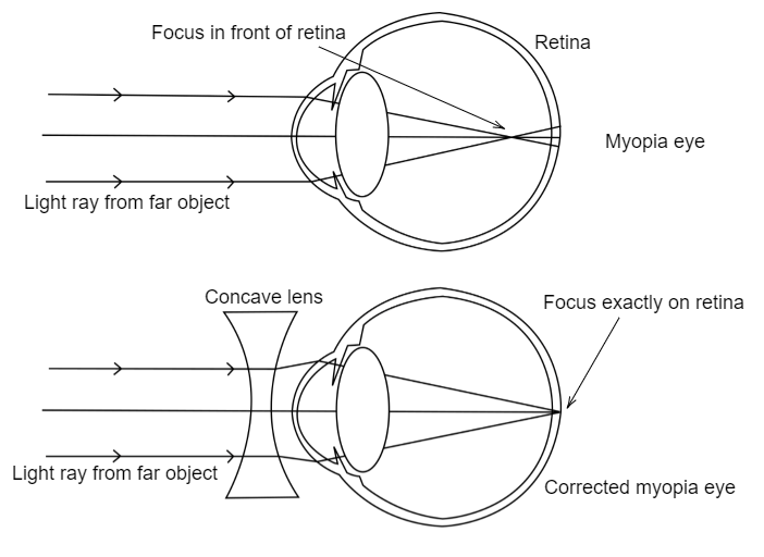 myopia diagram