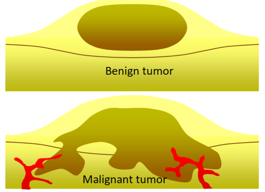 Benign And Malignant Tumor Difference 