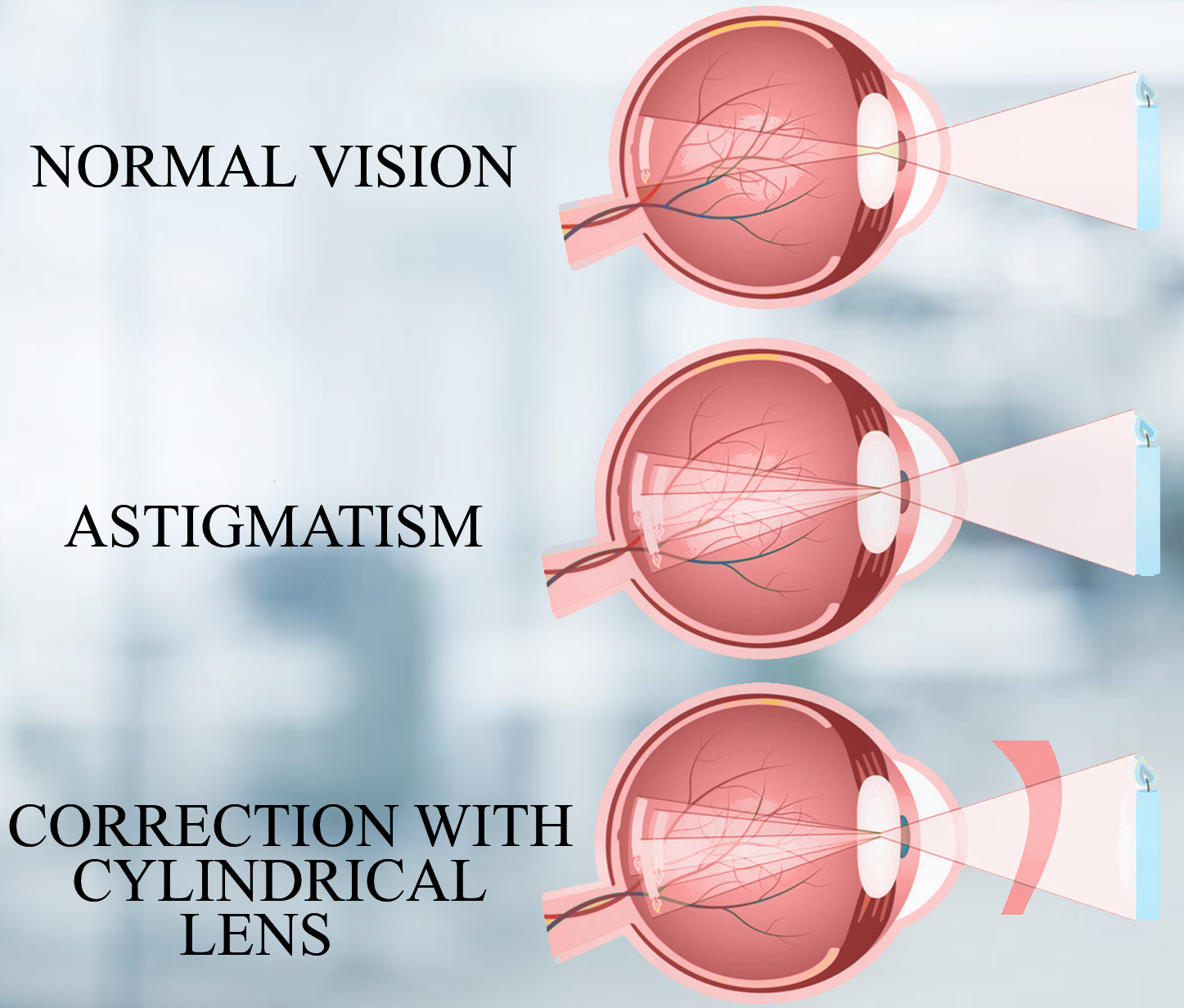 The Eye Defect Astigmatism Can Be Corrected By Using a Convex Lens b The Eye Defect Astigmatism Can Be Corrected By Using a Convex Lens b