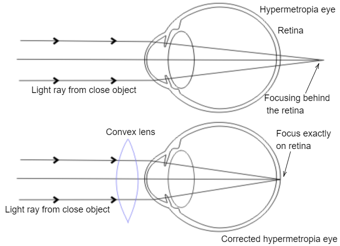 myopia correction diagram)