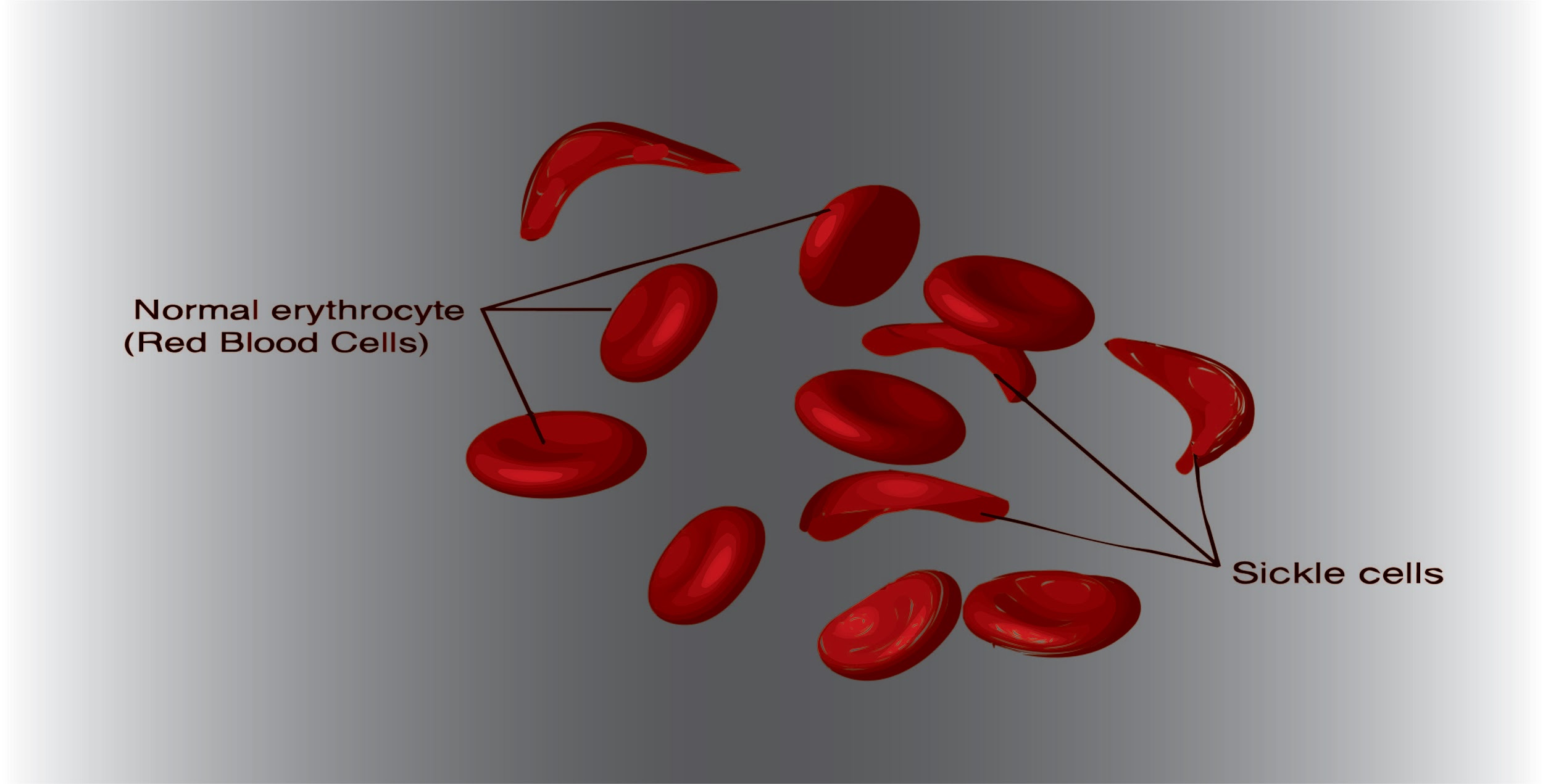 Sickle cell anemia is an example of aEpistasis ...