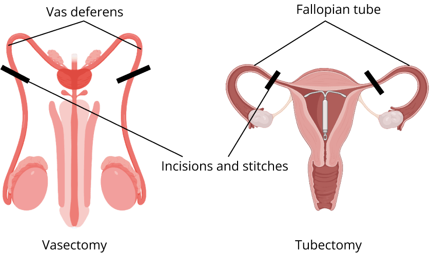 Vasectomy and Tubectomy
