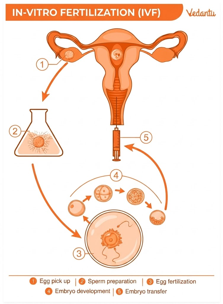 assisted reproductive technology diagram