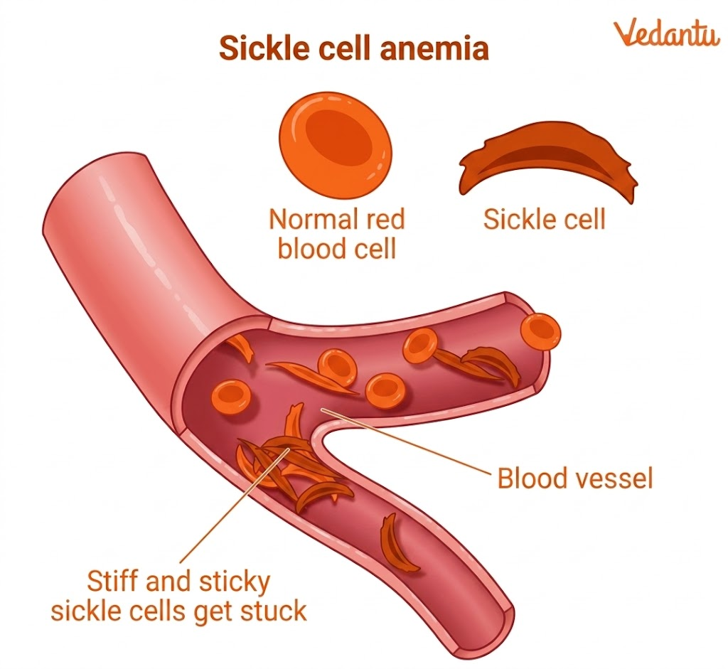 Diseases Related to Haemoglobin - Sickle Cell Anaemia