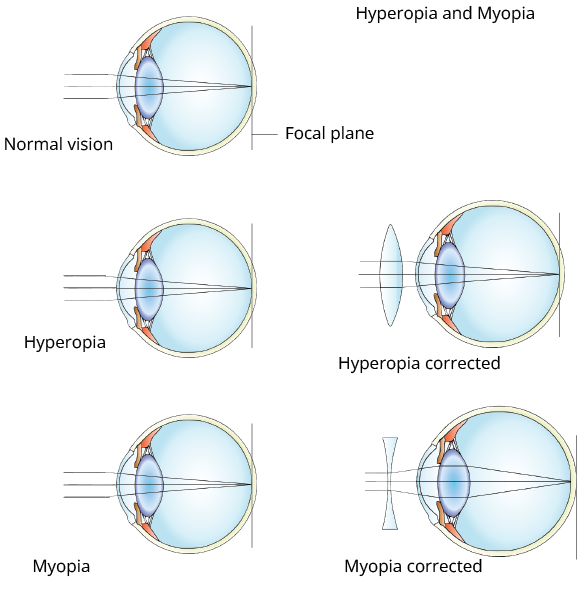 Showing eye defects and their corrections