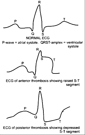 ECG Image