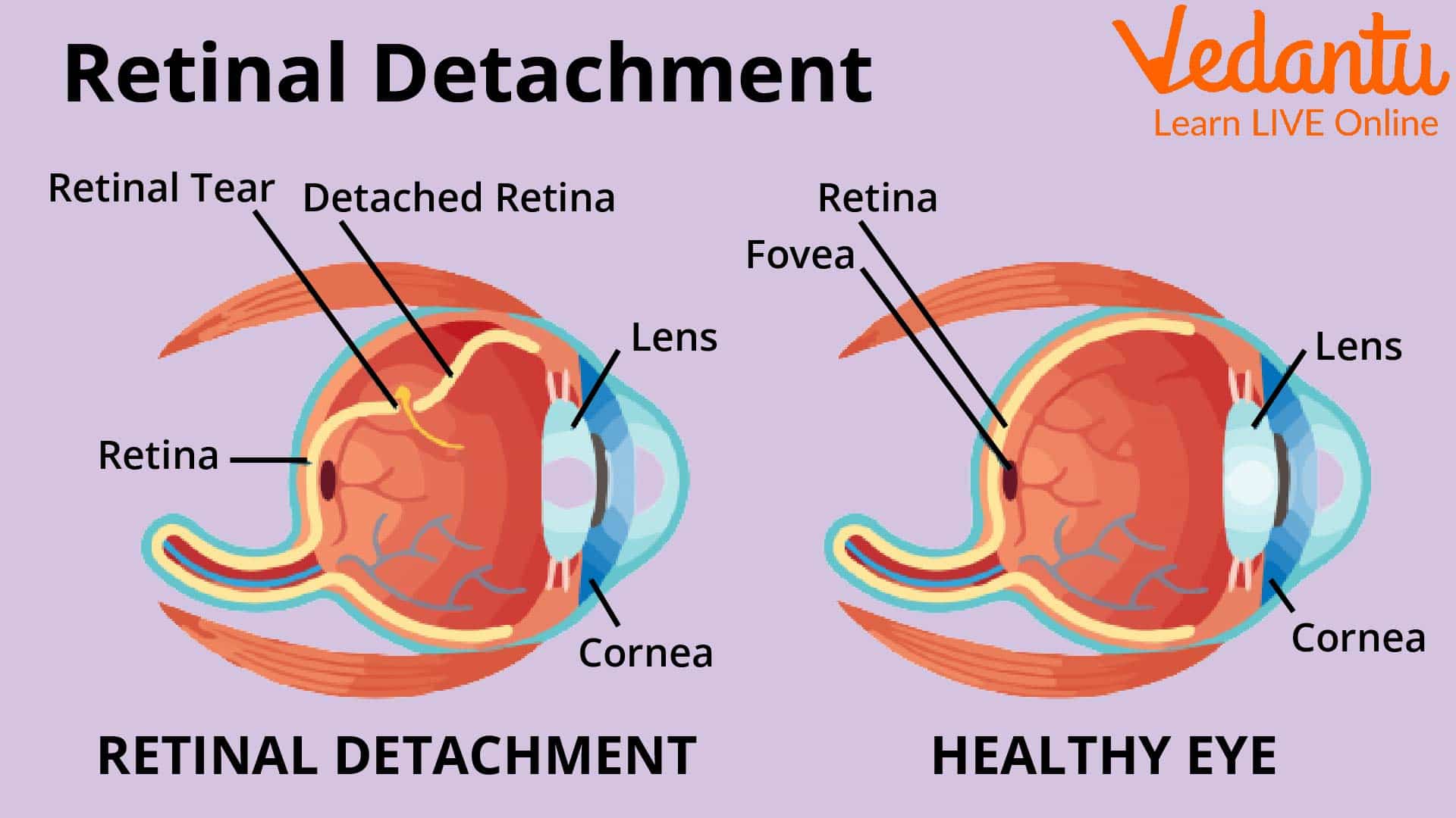 Retinal Detachment