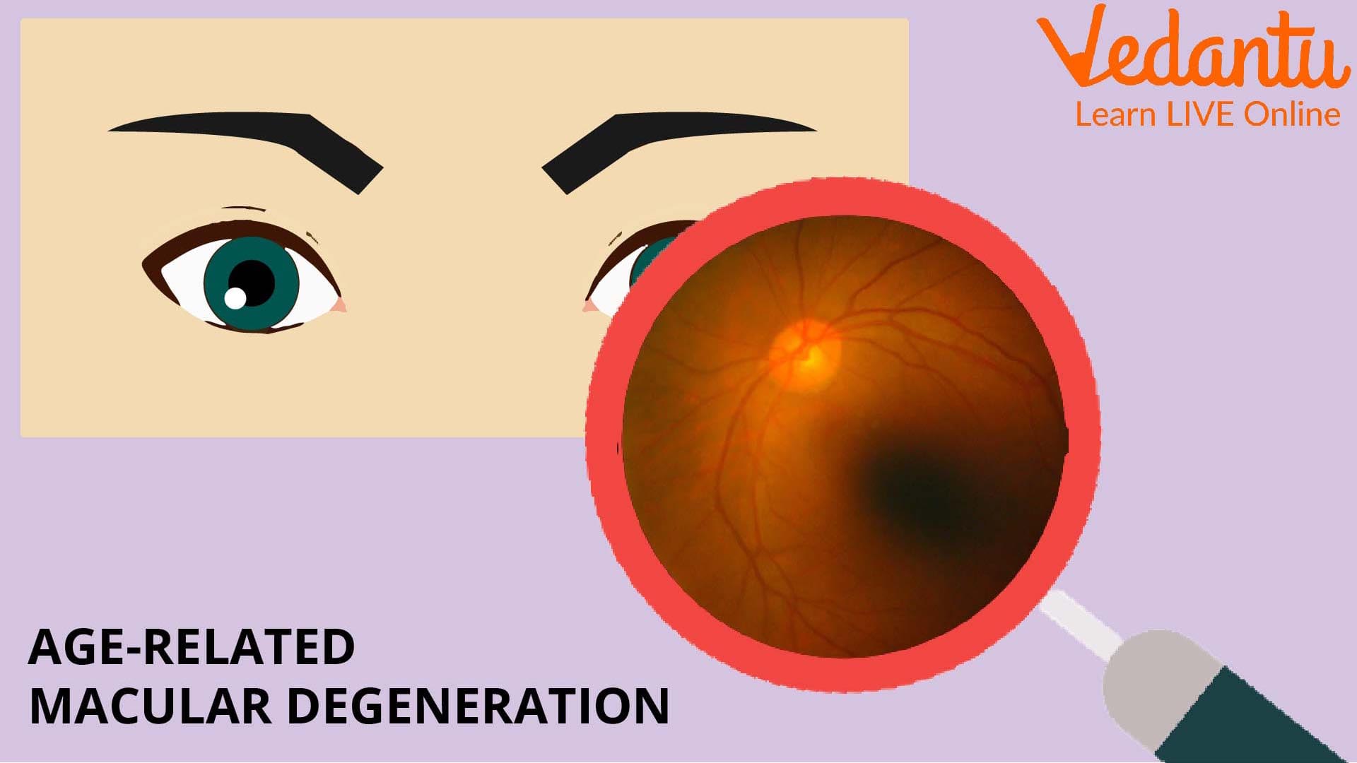 Age-Related Macular Degeneration