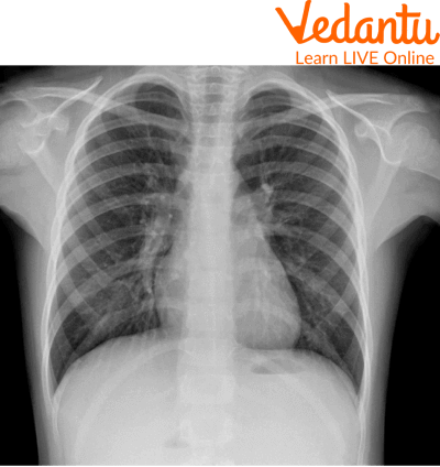 Chest x-ray