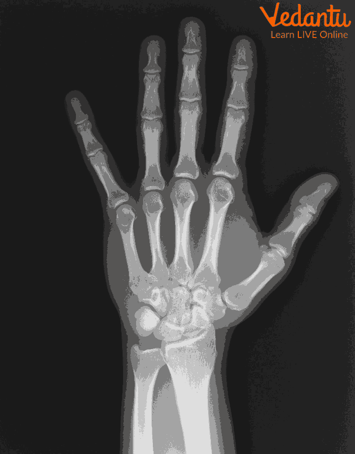 Bone x-ray